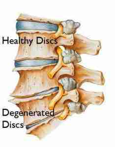 Low back pain causes