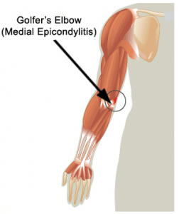 Golfer's Elbow