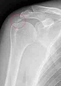 calcific tendonitis