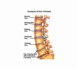 Lumbar disc and facet degeneration